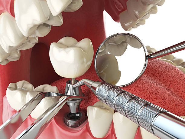 Best Dental Abscess Treatment in North Sioux City, SD